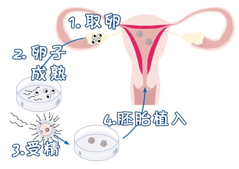 包生男孩第三代试管